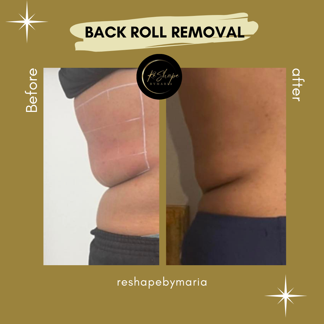 Back Roll Removal