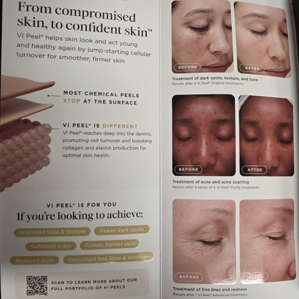 VI Peel ( Chemical Peel) at Glow Lab Aesthetics & Wellness, LLC in El Paso, TX
