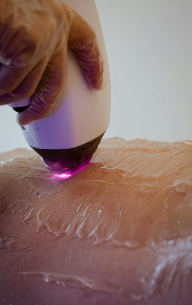 Brazilian Laser Hair Removal