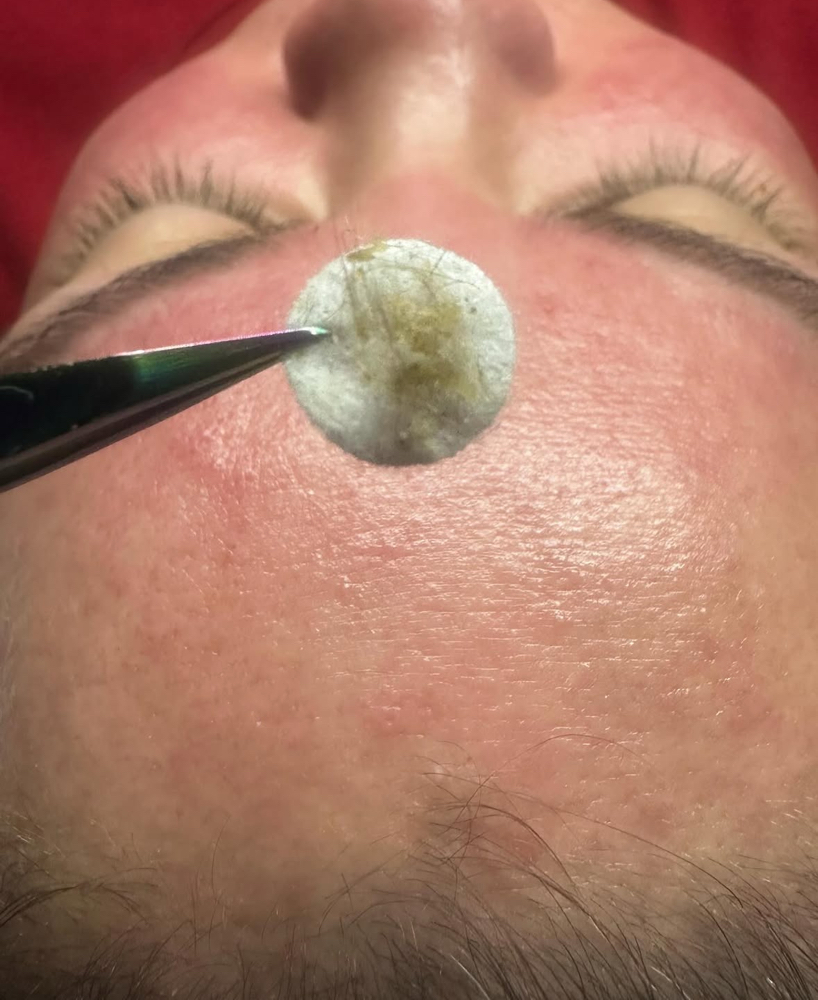 Microdermabrasion Facial