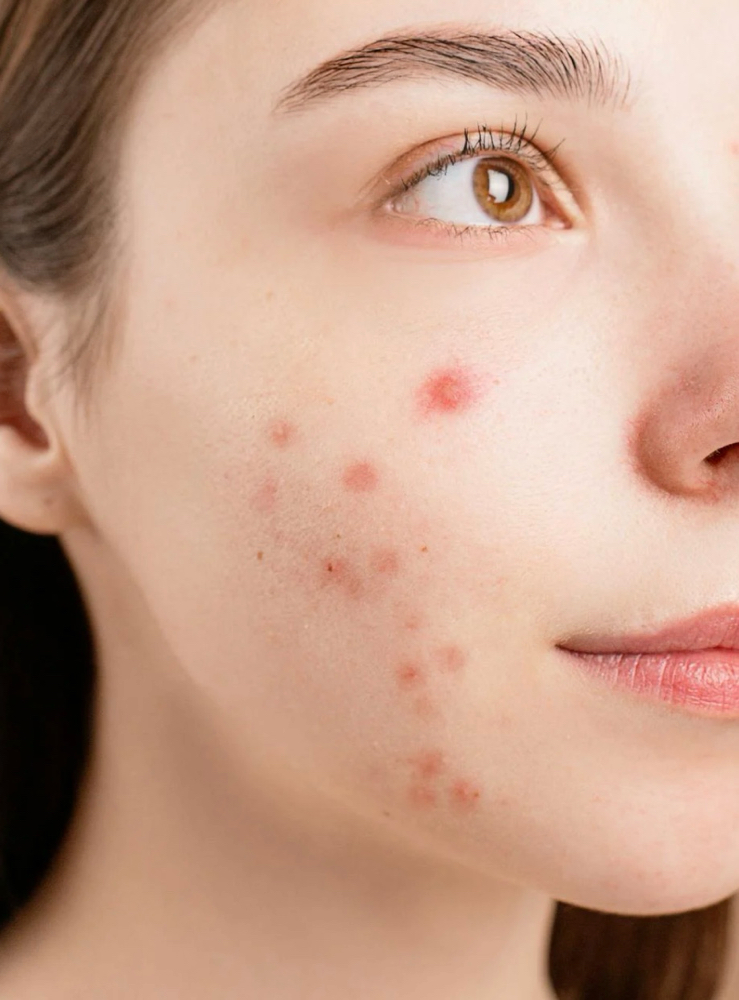 Face Reality First Acne Treatment