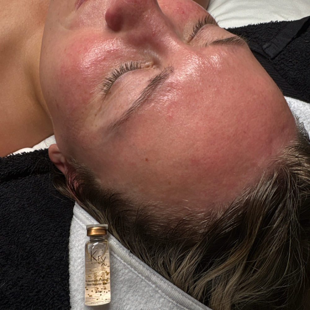 PDRN Ampoule Infusion at Aesthetics by Abby in Alliance, OH