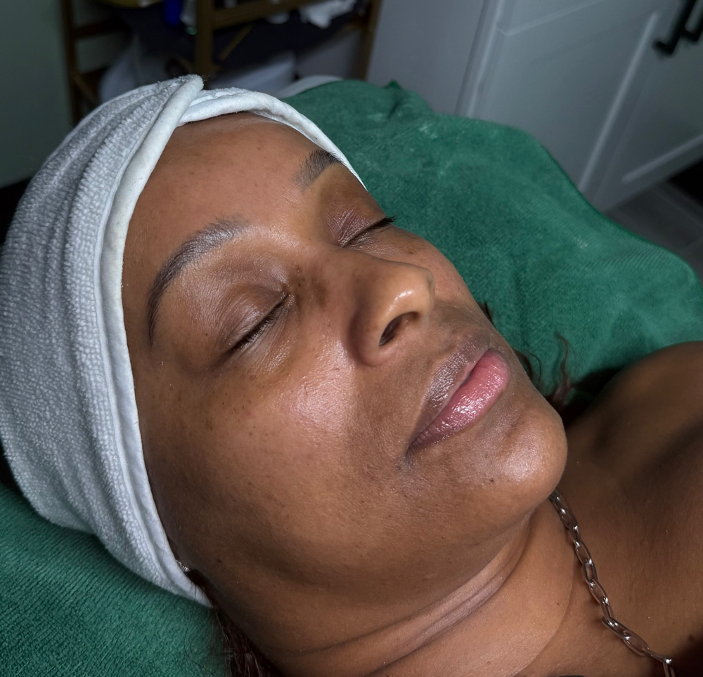 Microdermabrasion