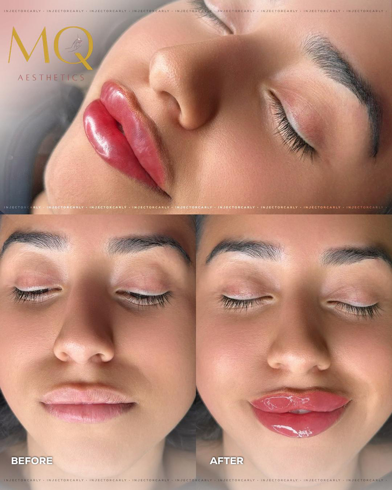 Lip & Chin Duo