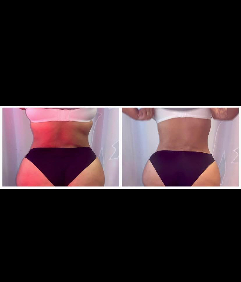 Back Cavitation