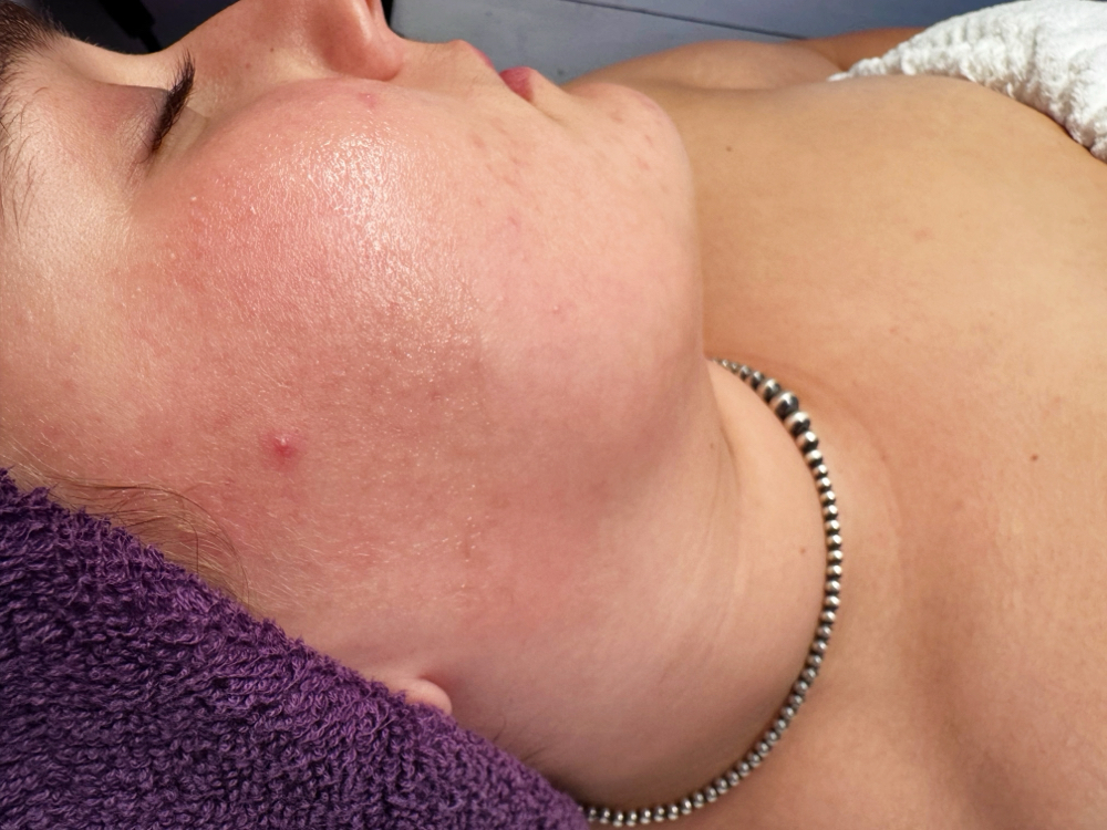 Dermaplaning at Abtsolute Beauty in Sioux Falls, SD