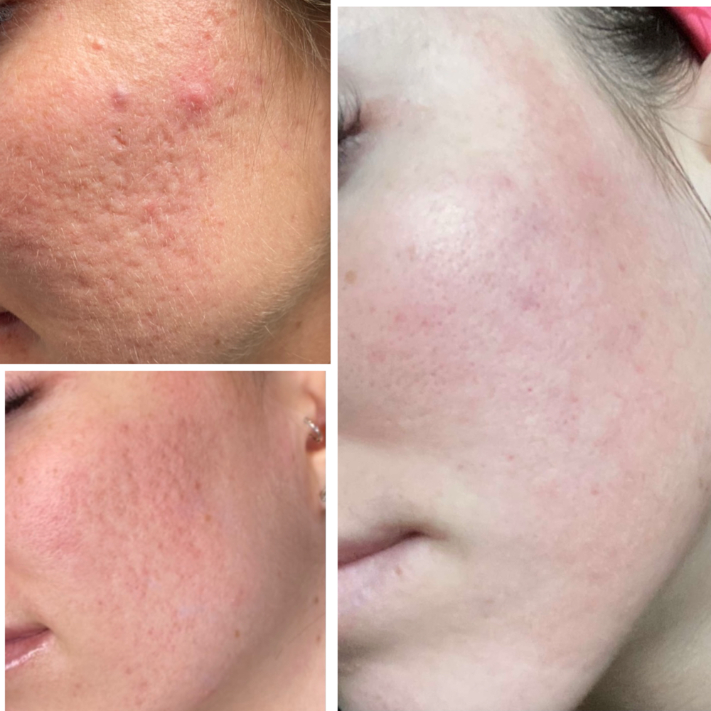 Plasma Pen Acne Scar Treatment