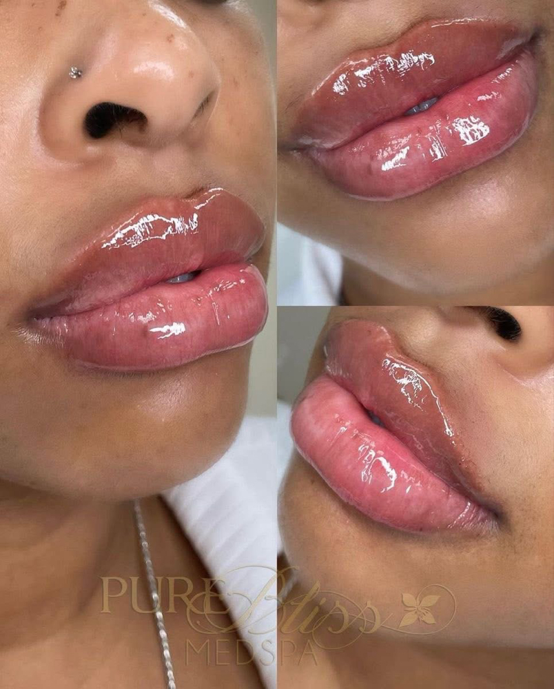 Lip Filler