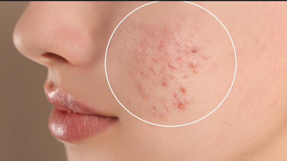 Acne Facial