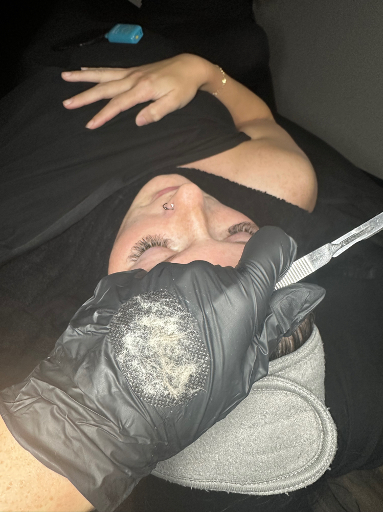 Dermaplaning