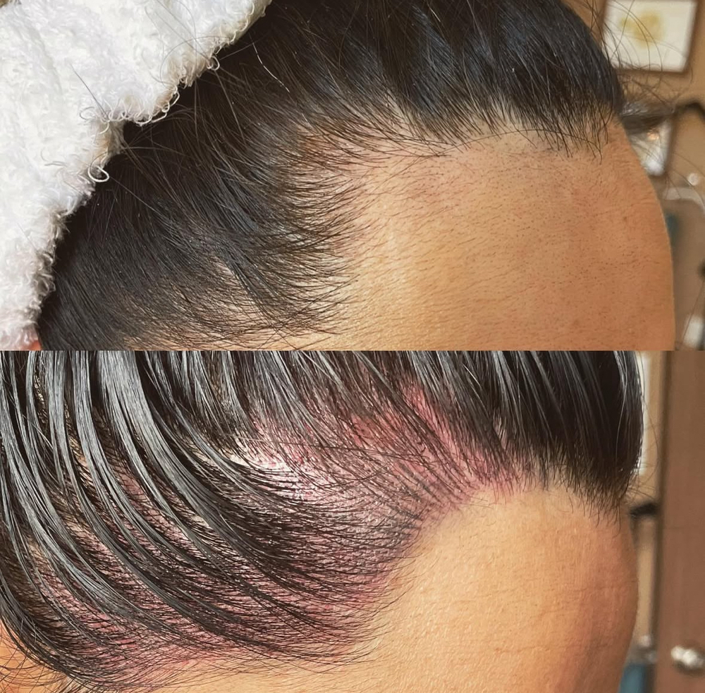 Hairline Regeneration
