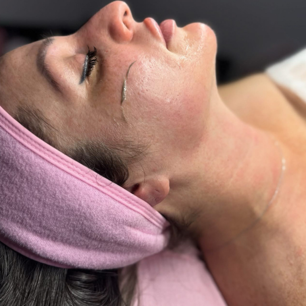 Dermaplane Facial at MLN Esthetics in West Springfield, MA