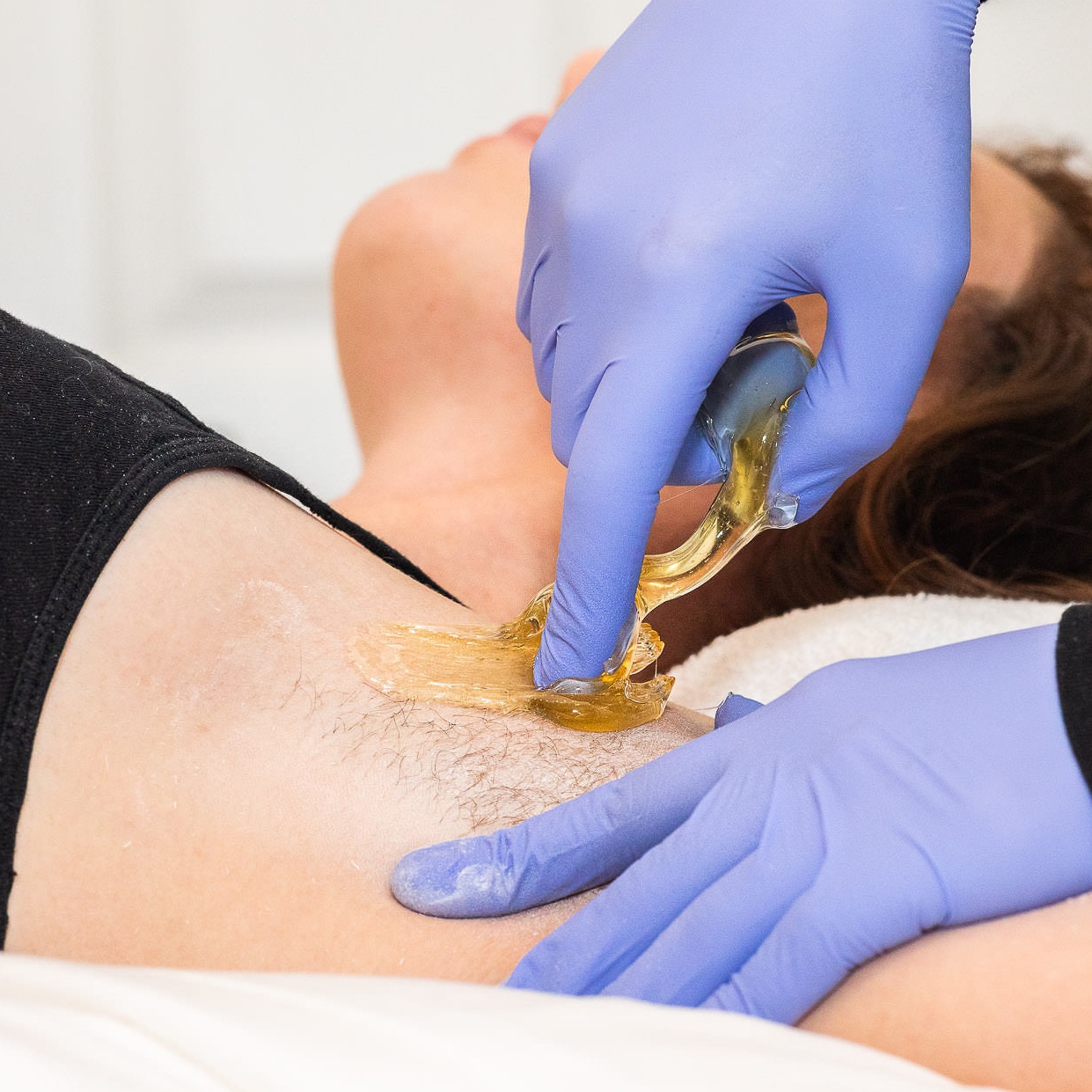 Underarms at SoLuna Aesthetics in Scottsdale, AZ