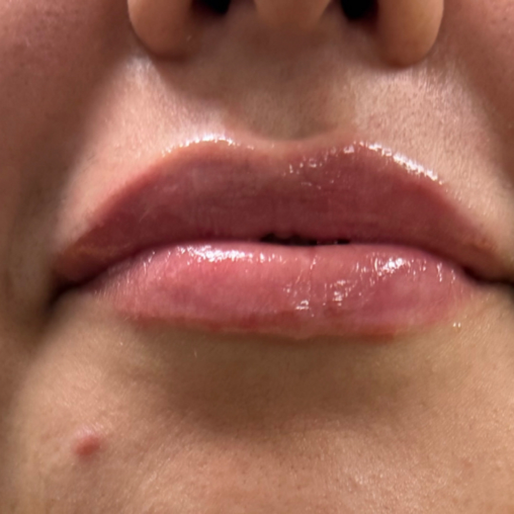 Lip Filler 1 ml at G5 Glamour in Pampa, TX