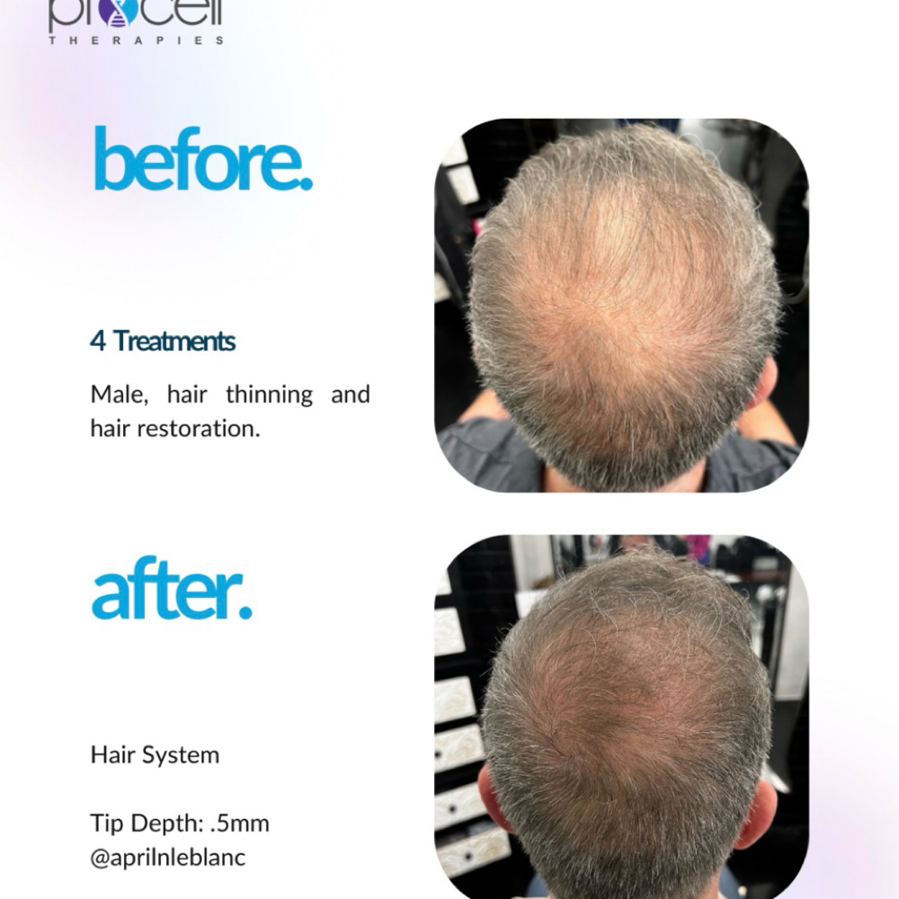 Hair Restoration Microchanneling at Blessed Beauty Aesthetics, LLC in Houston, TX
