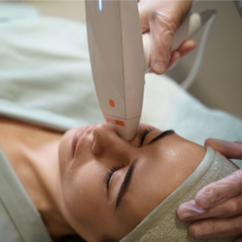 Venus Viva RF Microneedling