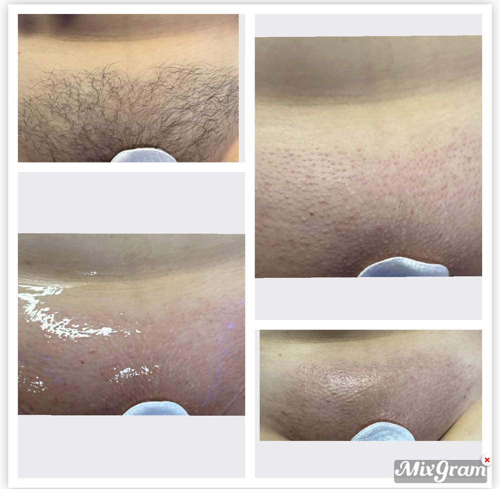Brazilian Wax