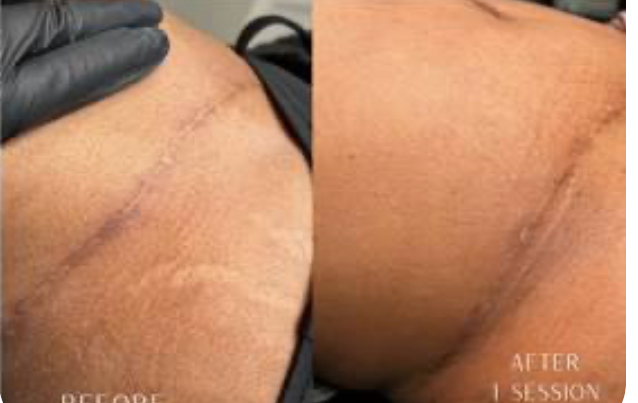 Surgical Tummy Tuck Scar 4 Sessions, Full Mid Section