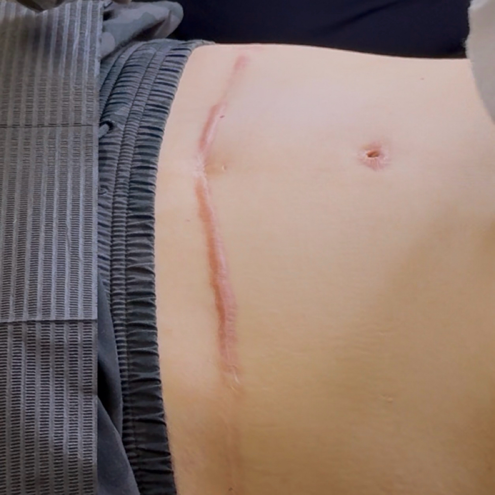 Scar Lightening Treatment at Skin Luminescence Co in Ft. Myers, FL