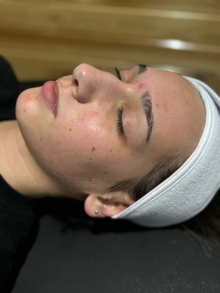 Acne Chemical Peel