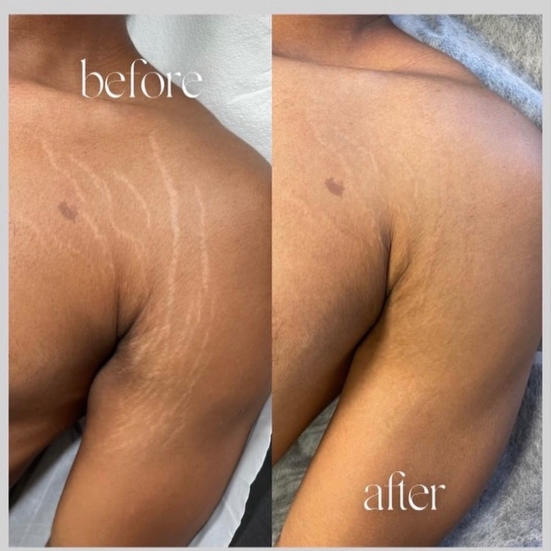 Stretch Mark Revision at Revive Skin by Ang in Downey, CA