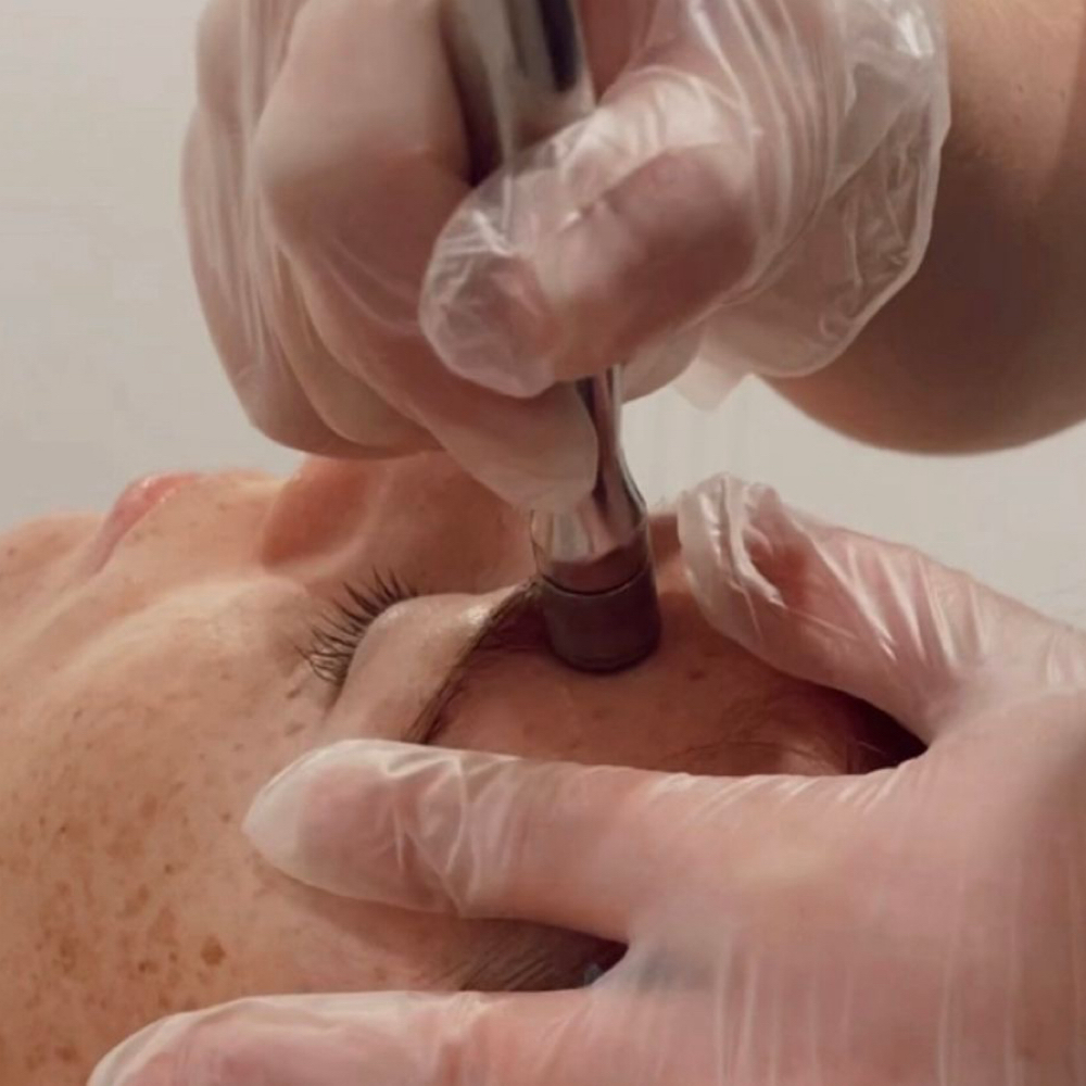 Microdermabrasion Facial at Psalms Aesthetics in Louisburg, KS