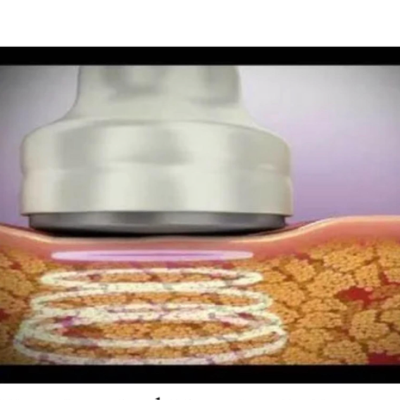 Non-Surgical Cavitation at Glo'Up Body Spa in Atlanta, GA