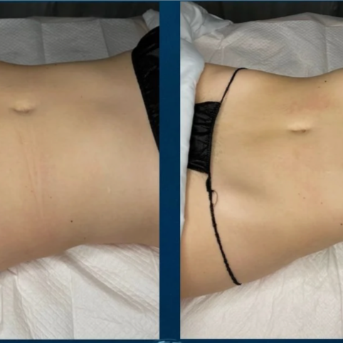 Non-Surgical Cavitation at Glo'Up Body Spa in Atlanta, GA