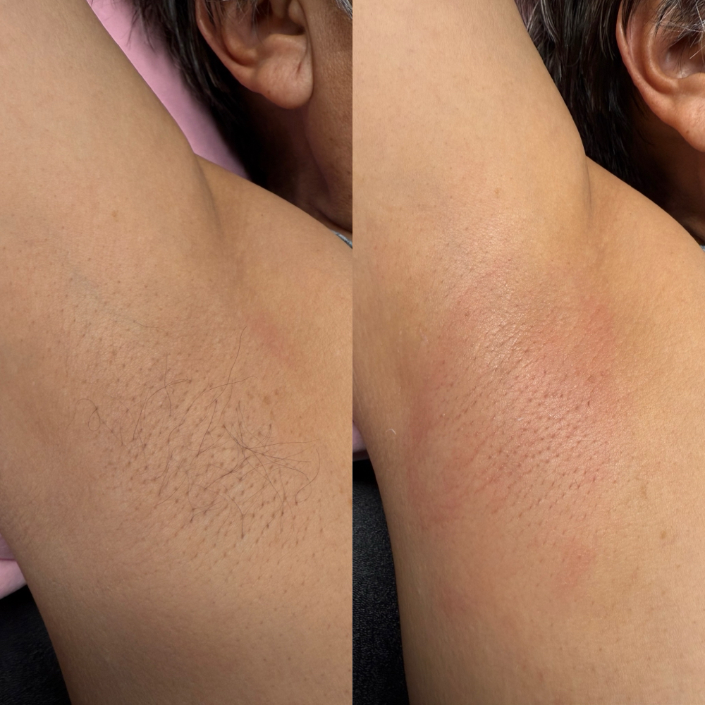UNDERARM WAX