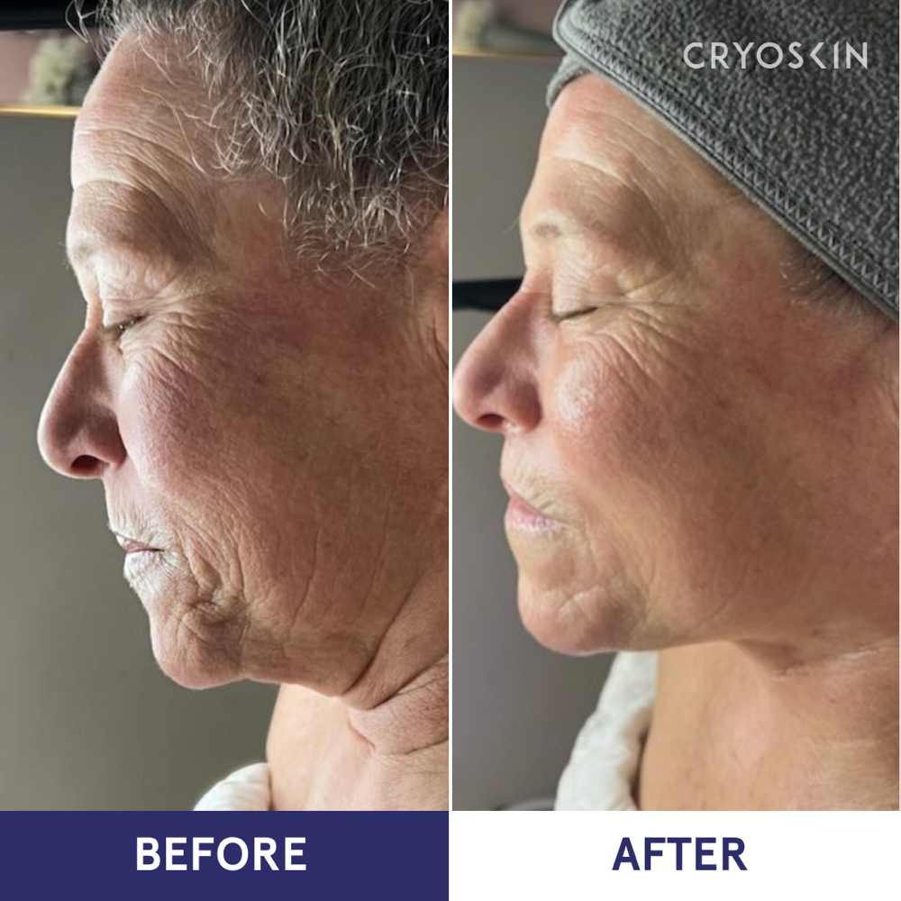 Cryoslimming Double chin