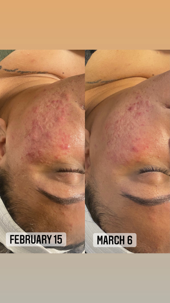 Acne Facial