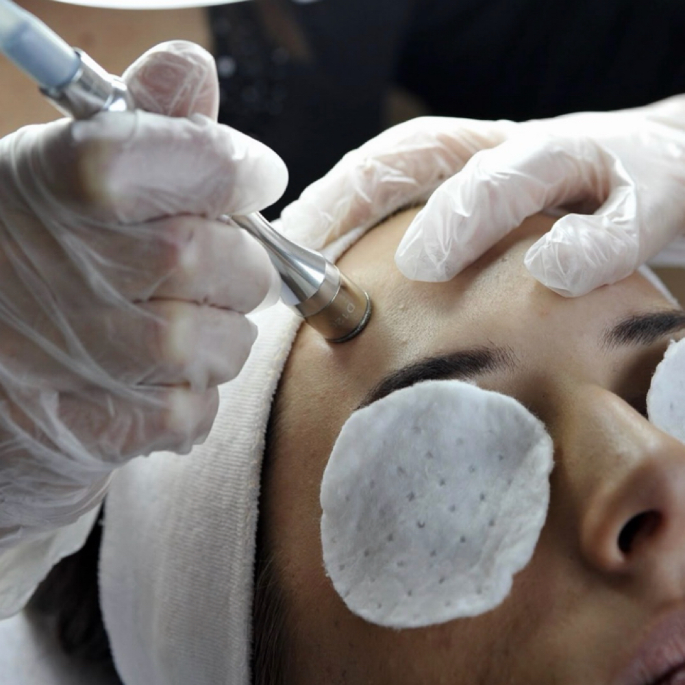 Diamond Facial at Retro Esthetics in San Clemente, CA