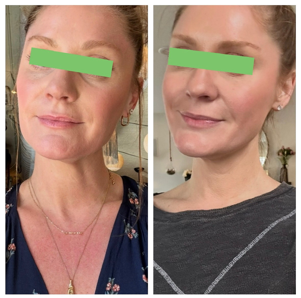 ULTHERAPY (face And Neck)