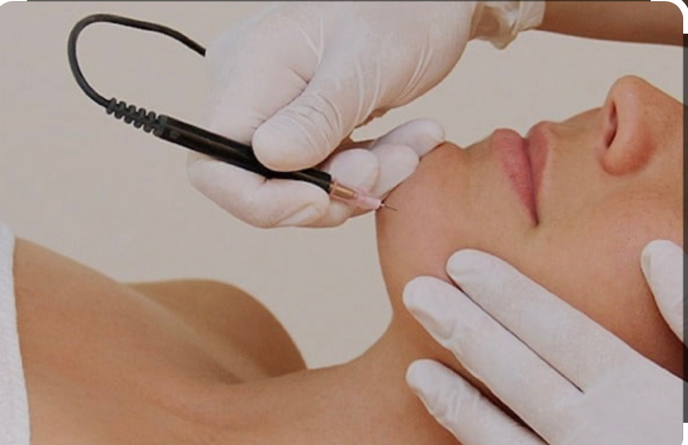 Electrolysis Permanent Hair Removal