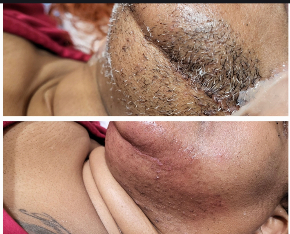 Hirsutism Treatment at Brandy The Esthetician in Shreveport, LA