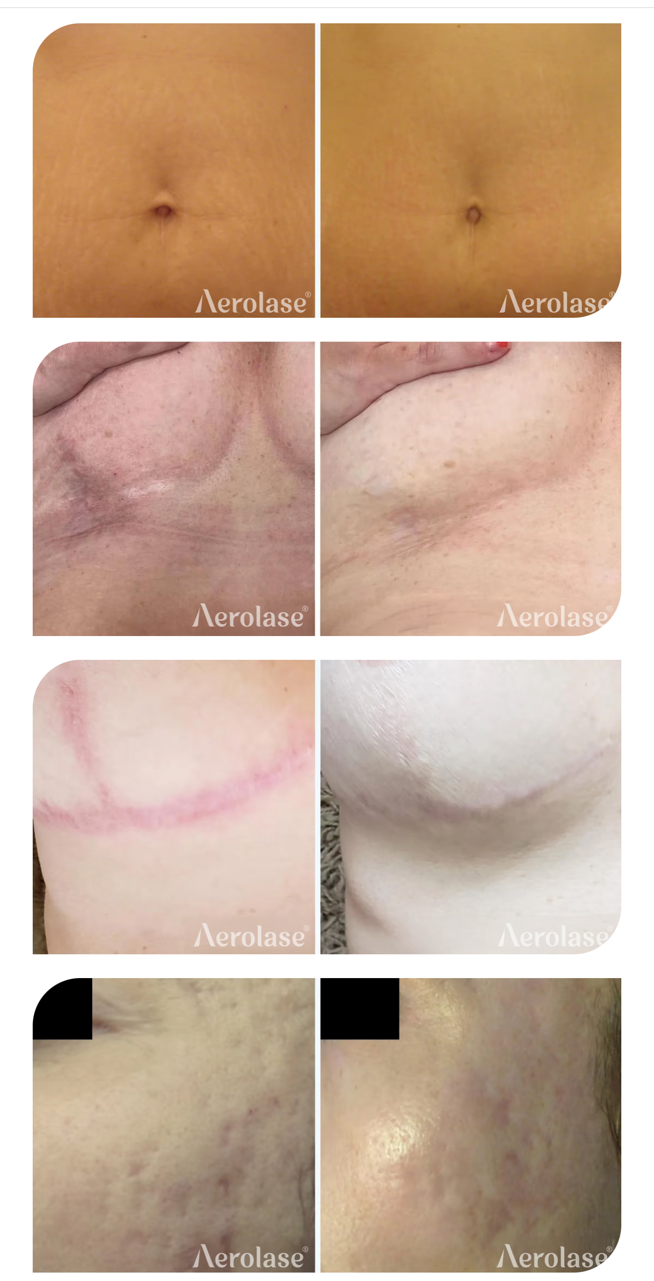 Scar Revision / Stretch Marks
