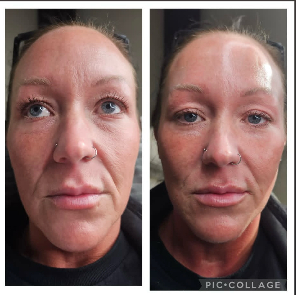 Chin, Cheek, Filler