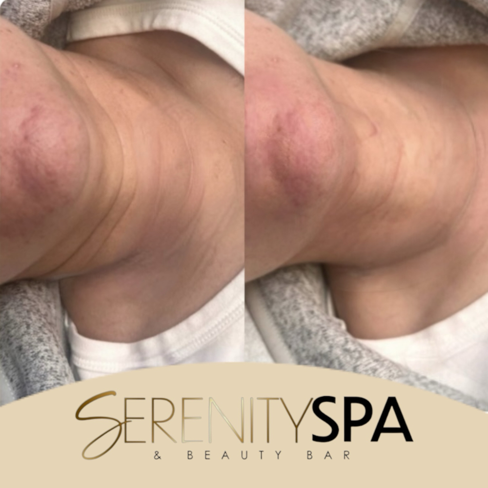 Mini Face/Chin/Neck Contouring at Serenity Spa & Beauty Bar in Warwick, RI