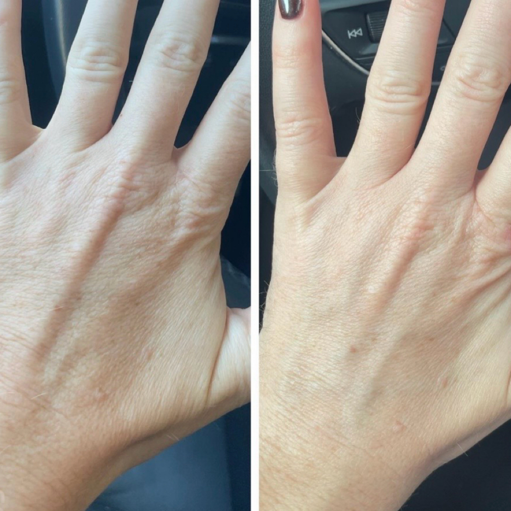 Add On Chemical Peel For Hands/Arms at Re Nu Esthetics by Trina in Ardmore, OK