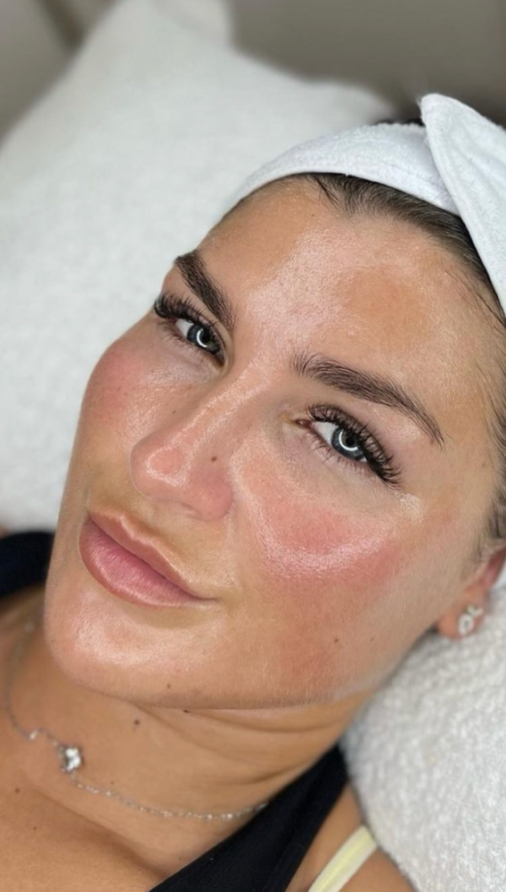 FACIAL PROFUNDO + PRP/MICRONEEDLING