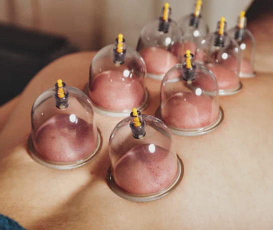 Cupping Add-on