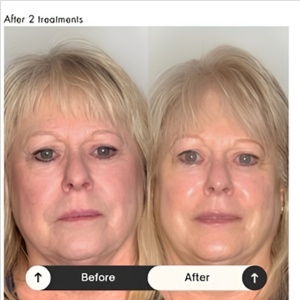 Time Master Lifting Facial at Marco Island Aesthetics