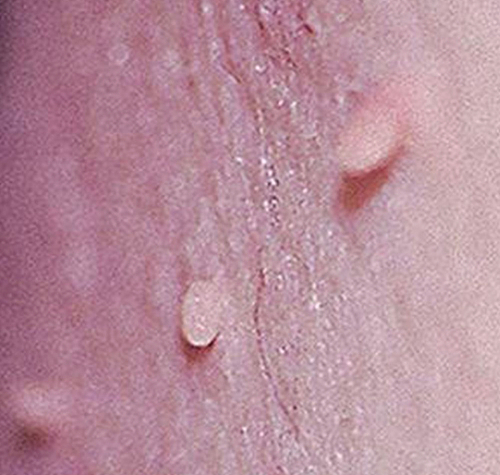 Skin Tag Removal ADD ON ONLY at Oasis Spa @ Ironwolf in Lake Havasu City, AZ