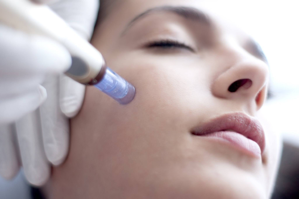 MICRONEEDLING