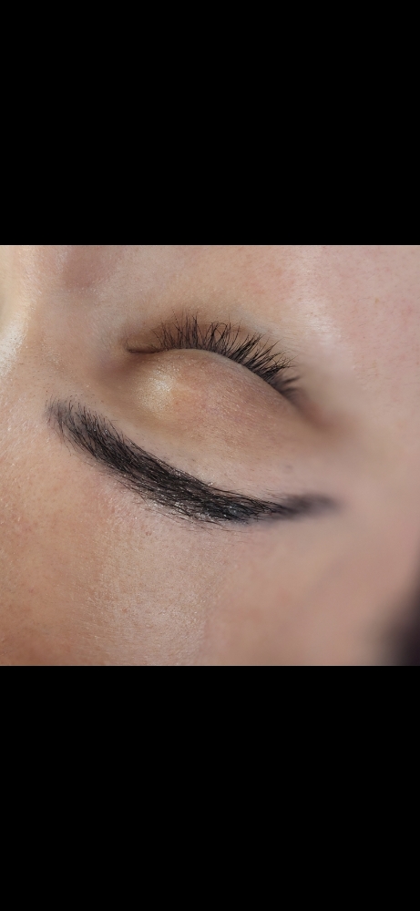 Saline Tattoo Removal Session