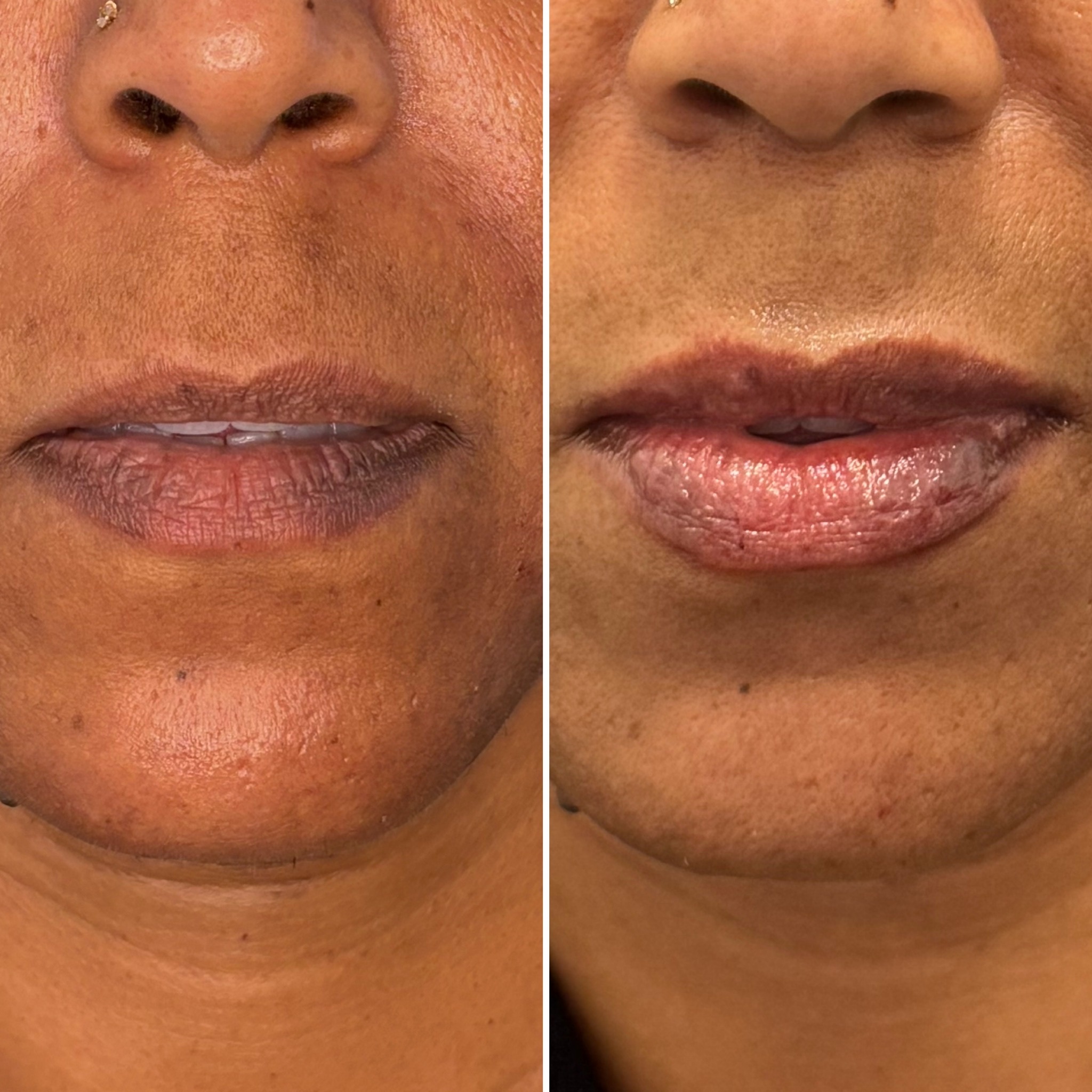 Neurotoxin Treatment at The Rejuvenation Suite Med Spa in New Rochelle, NY