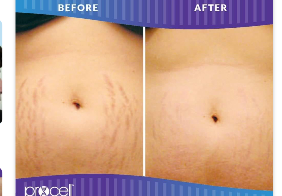 ProCell Scar Reduction