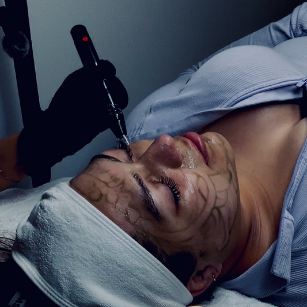 Nano Needle Facial at Welcome to Skin Beauty Aesthetics. in Wilson, NC