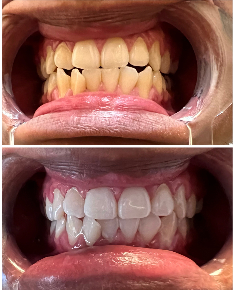 1 Hr Whitening Service