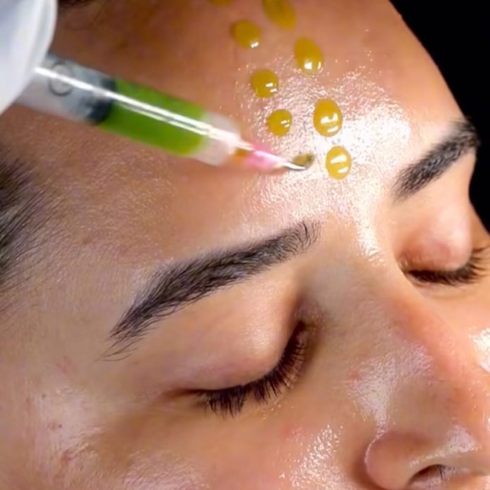Advanced Peel Facial at Skincare By Liliya in Sherman Oaks, CA